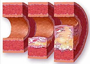 Stages of development of atherosclerotic plaques in hypertensive vessels